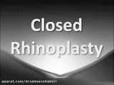 جراحی بینی بسته