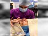 عمل زیبایی بینی گوشتی | دکتر گلی جراح بینی تهران