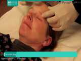 آموزش پاکسازی پوست | جوانسازی پوست صورت (درمان با درمارولر)