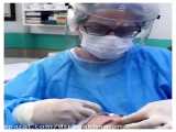 اصلاح فرم بینی با ژل بدون عمل جراحی