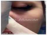 لیفت بینی با نخ در مطب دکتر رادا خانیان
