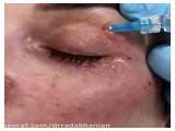 تزریق ژل جالپرو در پلک در مطب دکتر رادا خانیان