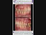نتیجه درمان ارتودنسی ثابت همراه با کشیدن دندان | دکتر فاضل فیروزی 