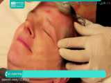 آموزش پاکسازی و جوانسازی پوست | پاکسازی صورت ( درمان جای جوش با درمارولر )