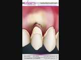 عدم رعایت بهداشت دهان و دندان و تحلیل لثه | کلینیک تخصصی دندانپزشکی کانسپتا 