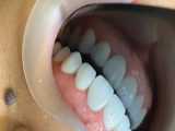 جراحی لثه   تعویض روکش قدیمی    لمینت سرامیکی دندان ها