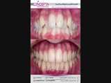 ارتودنسی ثابت دو فک بدون کشیدن دندان | کلینیک تخصصی دندانپزشکی 
