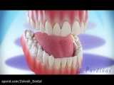 لمینیت یا ونیر دندان - کلینیک دندانپزشکی شبانه روزی زهره