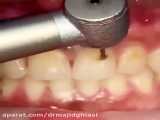 درمان پوسیدگی دندان-دکترمجیدقیاسی دندانپزشک زیبایی مشهد
