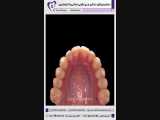 درمان چرخش دندانی و بی نظمی دندانی با ارتودنسی | دکتر فاضل فیروزی 