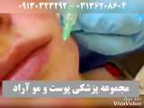 پی ار پی صورت