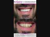 اصلاح طرح لبخند با استفاده از کامپوزیت ونیر فک بالا | کلینیک تخصصی دندانپزشکی کانسپتا 