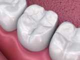 فیشورسیلانت در دندانپزشکی