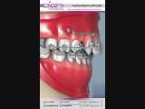 مینی اسکرو در ارتودنسی | کلینیک تخصصی دندانپزشکی کانسپتا 