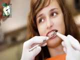 با پوسیدگی دندان ها قبل و در حین درمان ارتودنسی چه کنیم؟ | کلینیک دندانپزشکی ایده آل 