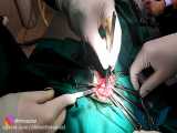 جراحی تومور کیسه مقعدی سمت چپ در یک قلاده سگ ماده نژاد شیتزو تریر