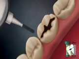 پرکردن دندان با مواد کامپوزیتی (مواد همرنگ دندان) | کلینیک تخصصی دندانپزشکی ایده آل 