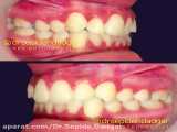 درمان ارتودنسي بدون كشيدن دندان | دکتر سپیده دادگر