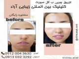 تزریق چربی به کل صورت