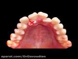 ارتودنسی کراس بایت با کشیدن دندان | دکتر داودیان