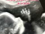 سونوگرافی شکار لحظه های خیلی خاص جنین توسط دکتر خواجه پور