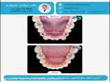 ارتودنسی ثابت با کشیدن چهار دندان آسیای کوچک در فک بالا و ‌فک پایین