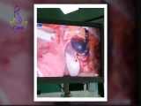 فیلم حاملگی خارج رحمی دو طرفه و جراحی به روش لاپاراسکوپی 
