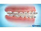 درمان اپن بایت یا فاصله دندانهای جلو با ارتودنسی ثابت | دکتر احسان مهریزی
