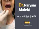 تخلیه ژل لب بعد از گذشت زمان | دکتر مریم ملکی متخصص پوست اصفهان