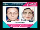 جراحی زیبایی بینی | جراح بینی در مشهد | دکتر زرین قلم