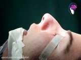 فیلم واقعی جراحی زیبایی بینی بعد از عمل توده بینی