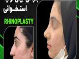 3 هفته بعد از جراحی بینی استخوانی | دکتر باستانی نژاد بهترین جراح بینی تهران