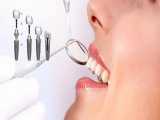 چگونه ایمپلنت دندان در دهان قرار داده می شود