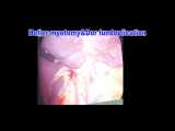 laprascopic heller myotomyDor fundoplocation and mucosal repaire by Dr mora