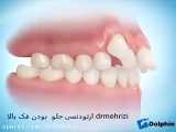 ارتودنسی جلو بودن فک بالا با ارتودنسی ثابت و کشیدن دو دندان | دکتر احسان مهریزی
