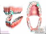 دانلود انیمیشن کشیدن دندان در ارتودنسی | دندانستان - انیمیشن 2020