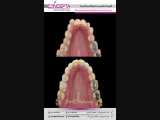 درمان ارتودنسی ثابت دو فک همراه با کشیدن دندان | کلینیک تخصصی دندانپزشکی کانسپتا 