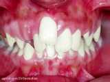 ارتودنسی بدون کشیدن دندان به کمک سیستم دیمون | دکتر داودیان