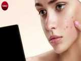 درمان جوش صورت با ده روش خانگی