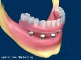ثابت کردن دندان مصنوعی