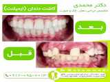 کاشت دندان- کاشت ایمپلنت دندان۰۹۱۲۰۹۵۷۰۱۳