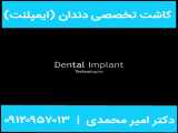 کاشت تخصصی دندان - کاشت ایمپلنت اقساط