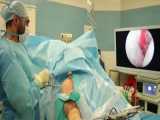 آرتروسکوپی شانه - دکتر علی کوشان - فوق تخصص جراحی شانه و دست