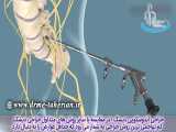 درمان کامل آندوسکوپیک ستون فقرات | متخصص ارتوپد | دکتر محمد ابراهیم طاهریان 