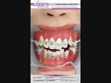 کشیدن دندان در ارتودنسی | کلینیک تخصصی دندانپزشکی کانسپتا 