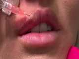 آموزش تزریق ژل لب مدل روسی 