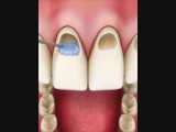 کاربردهای کامپوزیت | کلینیک دندانپزشکی ایده آل 