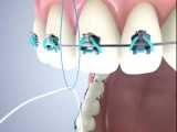 نخ دندان ارتودنسی | دکتر احسان مهریزی 