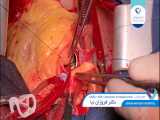 عمل جراحي CABG AVR Aneurysm of valsalva sinus در بيمار ٦٠ساله