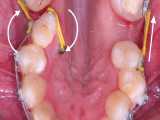 ارتودنسی چرخش دندان | دکتر داودیان